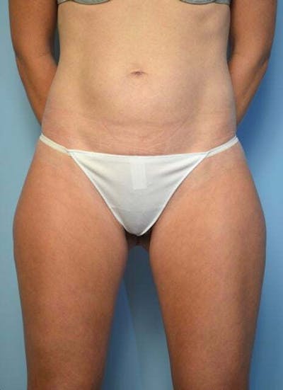Umbilical Float Tummy Tuck Before & After Gallery - Patient 752417 - Image 1