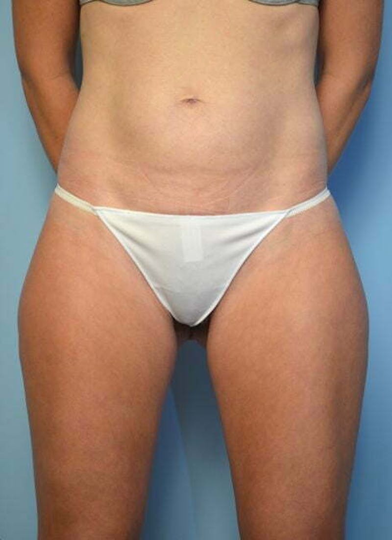 Umbilical Float Tummy Tuck Before & After Gallery - Patient 752417 - Image 1