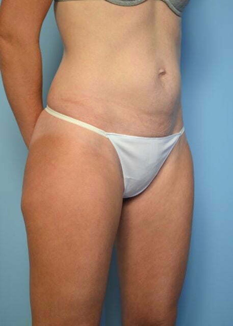 Umbilical Float Tummy Tuck Before & After Gallery - Patient 752417 - Image 3