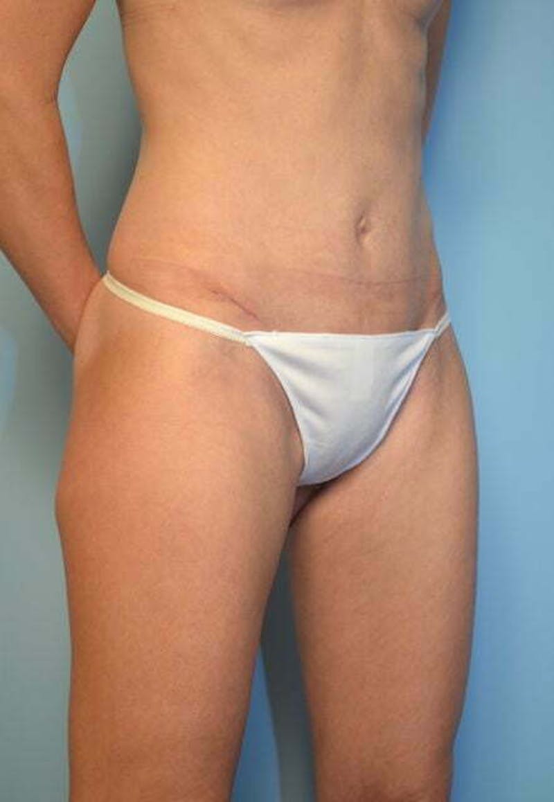 Umbilical Float Tummy Tuck Before & After Gallery - Patient 752417 - Image 4