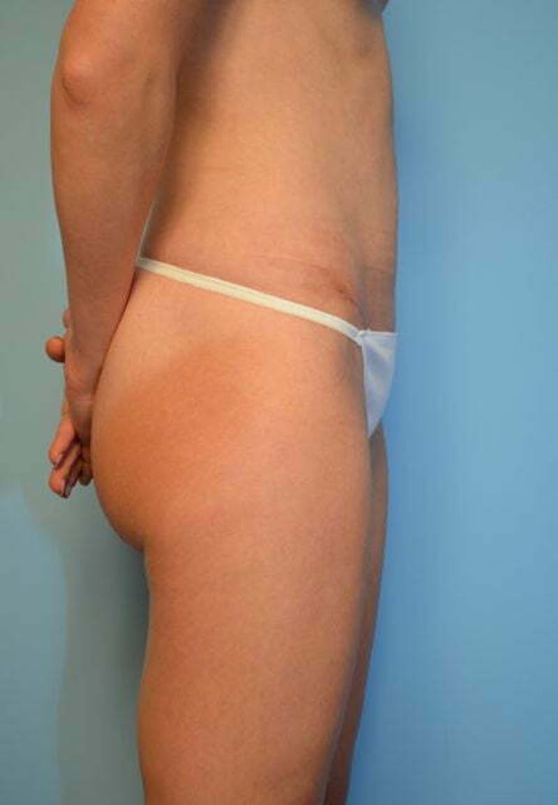 Umbilical Float Tummy Tuck Before & After Gallery - Patient 752417 - Image 6