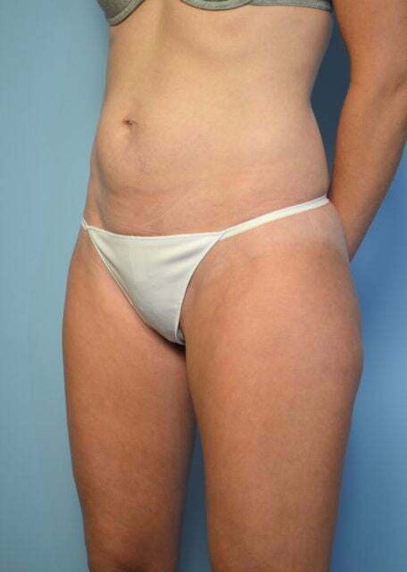 Umbilical Float Tummy Tuck Before & After Gallery - Patient 752417 - Image 7