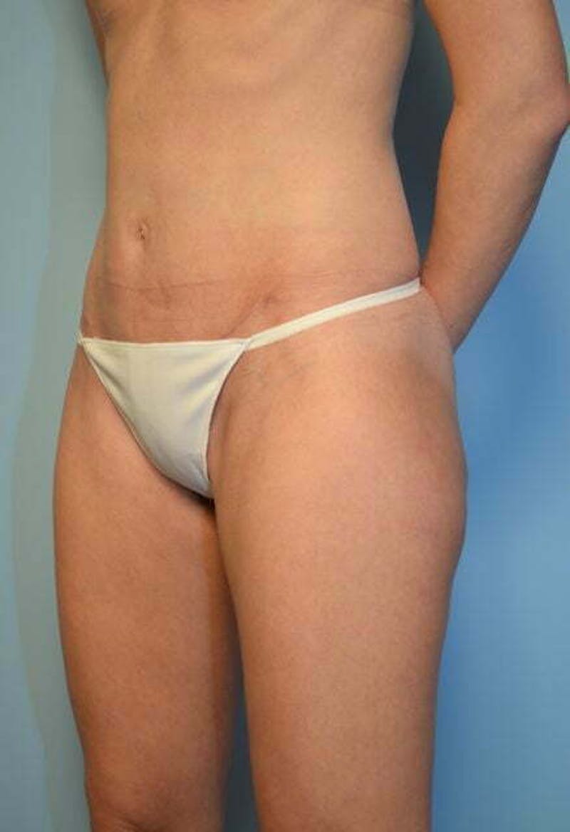 Umbilical Float Tummy Tuck Before & After Gallery - Patient 752417 - Image 8