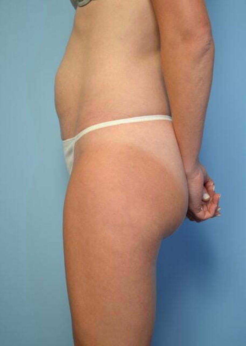 Umbilical Float Tummy Tuck Before & After Gallery - Patient 752417 - Image 9