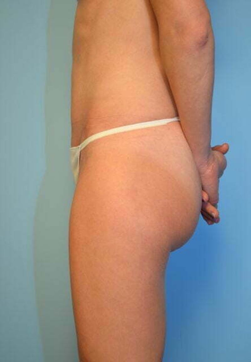 Umbilical Float Tummy Tuck Before & After Gallery - Patient 752417 - Image 10