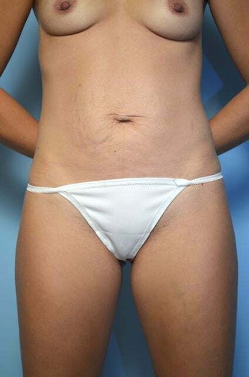 Umbilical Float Tummy Tuck Before & After Gallery - Patient 211942 - Image 1