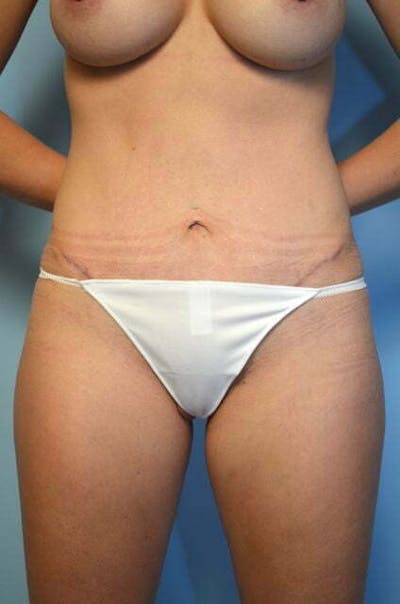 Umbilical Float Tummy Tuck Before & After Gallery - Patient 211942 - Image 2