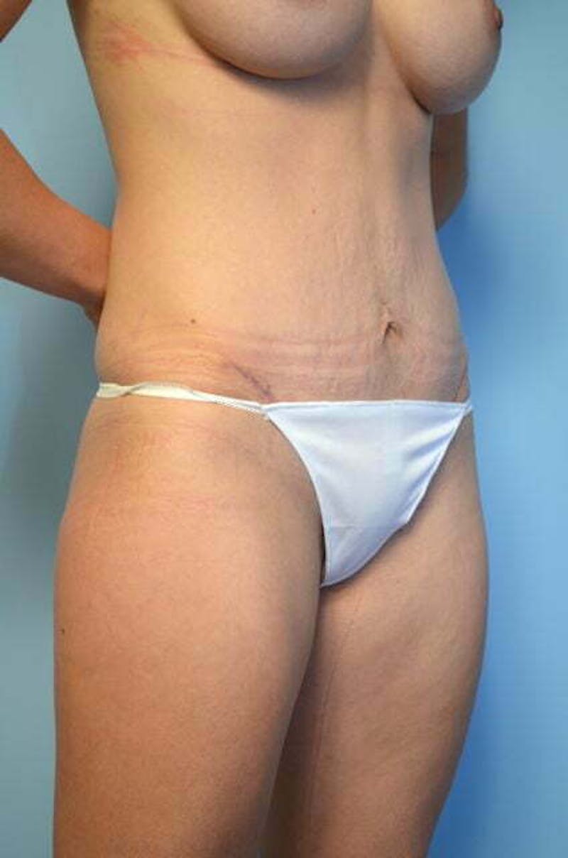 Umbilical Float Tummy Tuck Before & After Gallery - Patient 211942 - Image 4