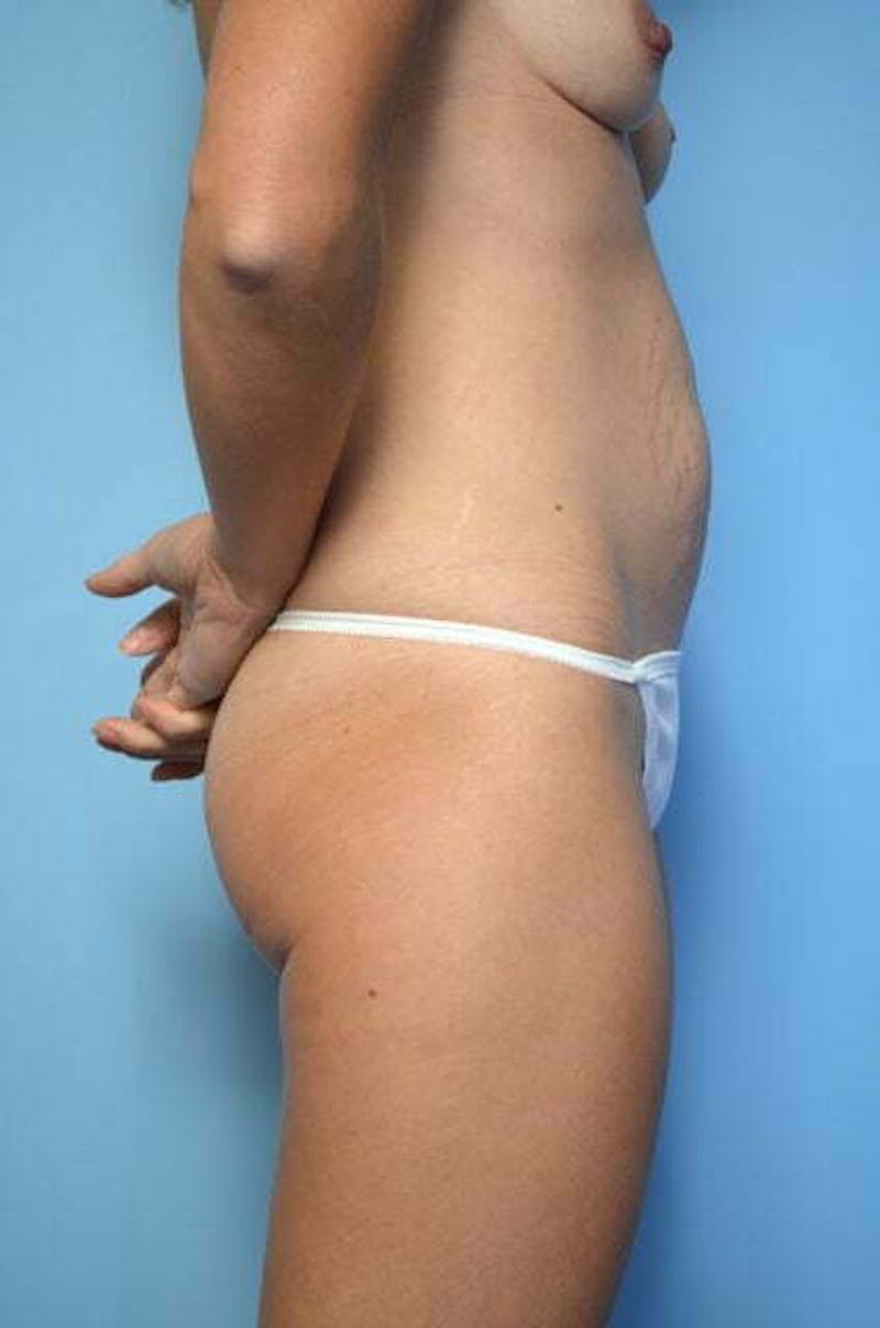 Umbilical Float Tummy Tuck Before & After Gallery - Patient 211942 - Image 5