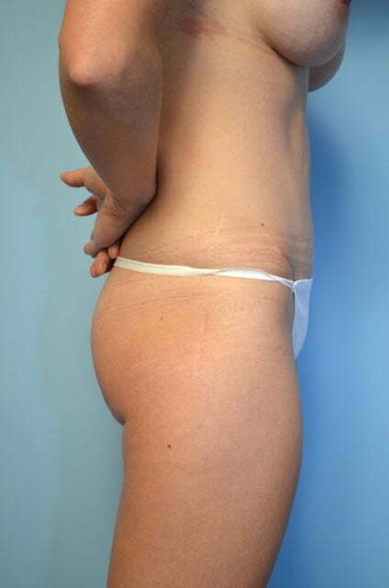 Umbilical Float Tummy Tuck Before & After Gallery - Patient 211942 - Image 6