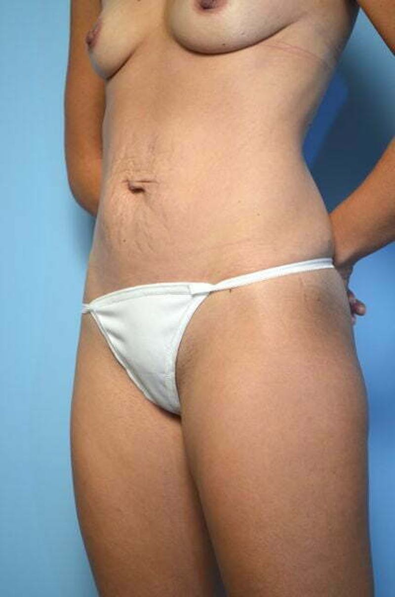 Umbilical Float Tummy Tuck Before & After Gallery - Patient 211942 - Image 7