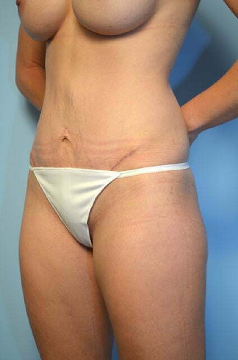 Umbilical Float Tummy Tuck Before & After Gallery - Patient 211942 - Image 8