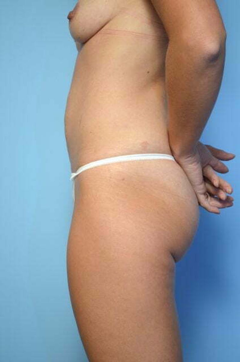Umbilical Float Tummy Tuck Before & After Gallery - Patient 211942 - Image 9