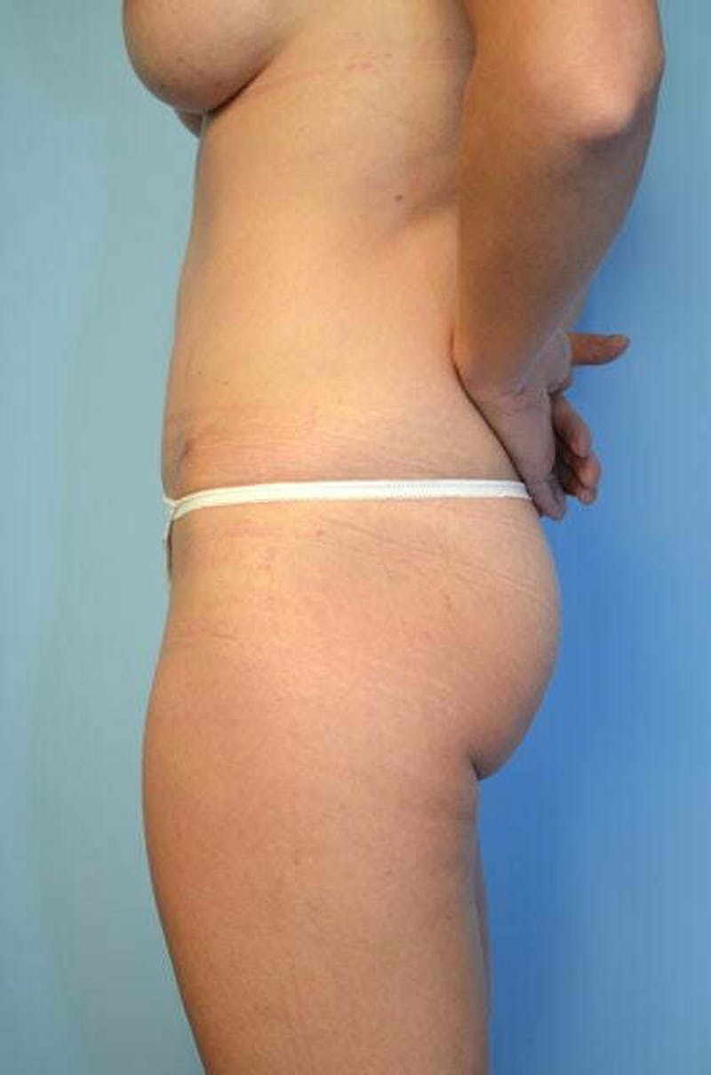 Umbilical Float Tummy Tuck Before & After Gallery - Patient 211942 - Image 10
