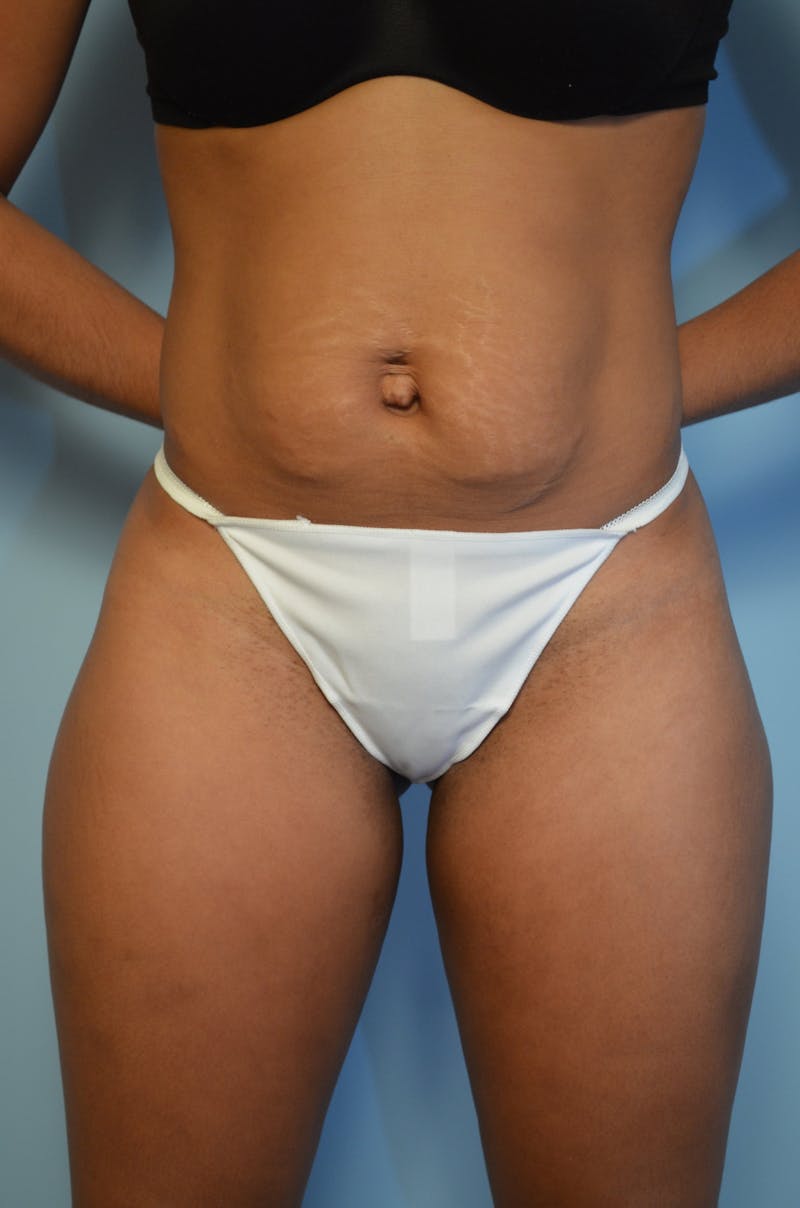 Umbilical Float Tummy Tuck Before & After Gallery - Patient 283086 - Image 1