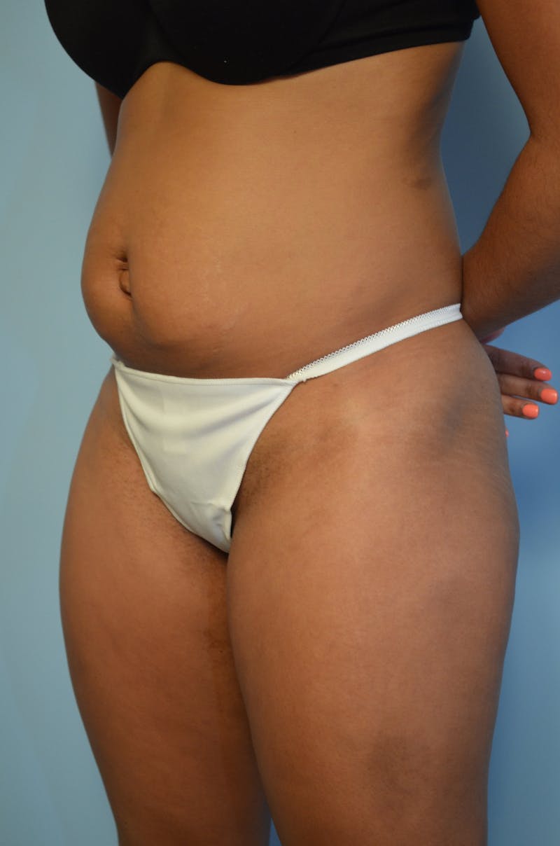 Umbilical Float Tummy Tuck Before & After Gallery - Patient 283086 - Image 7