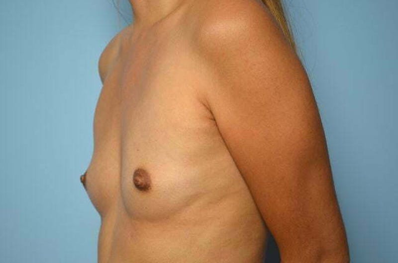 Breast Augmentation Before & After Gallery - Patient 128049 - Image 7
