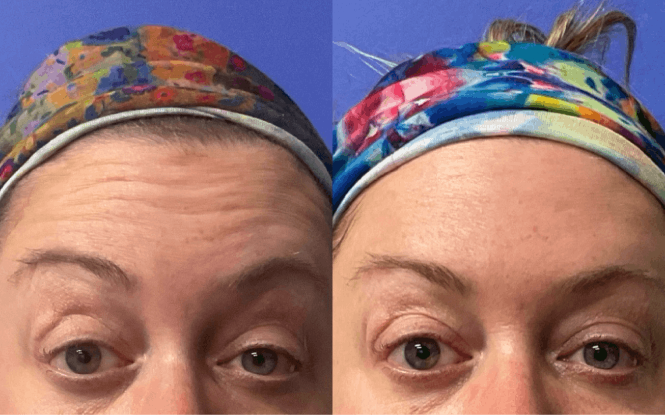 Botox