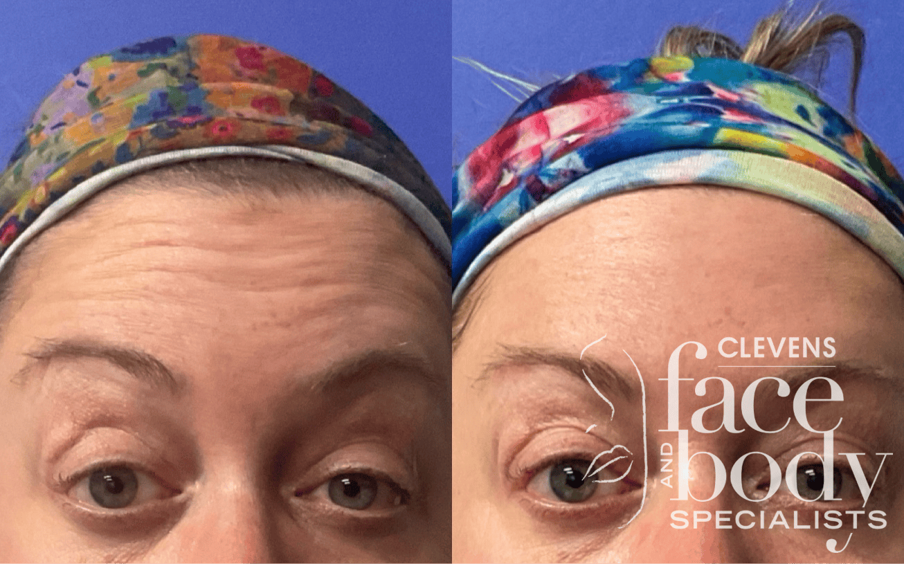 Botox
