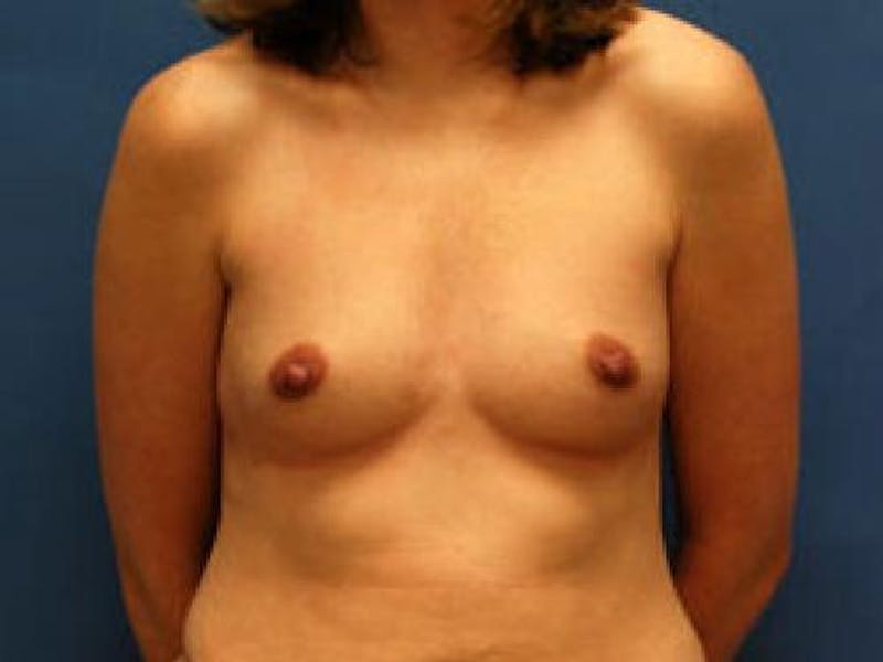 Breast Augmentation Before & After Gallery - Patient 355053 - Image 1