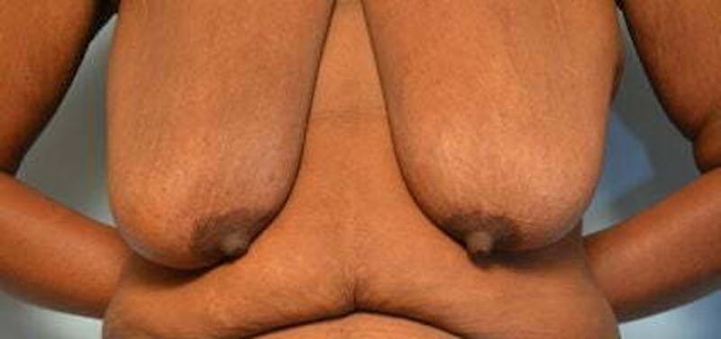 Breast Lift Before & After Gallery - Patient 399042 - Image 1