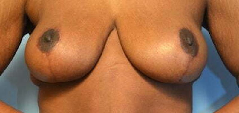 Breast Lift Before & After Gallery - Patient 399042 - Image 2