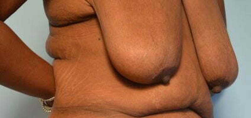 Breast Lift Before & After Gallery - Patient 399042 - Image 3