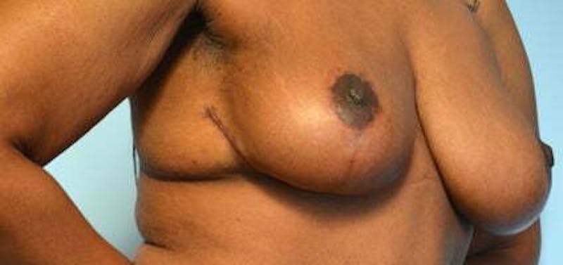 Breast Lift Before & After Gallery - Patient 399042 - Image 4