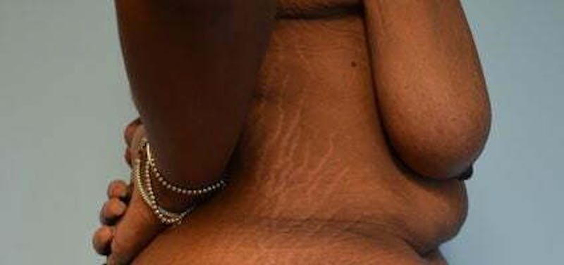 Breast Lift Before & After Gallery - Patient 399042 - Image 5