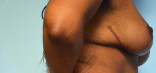 Breast Lift Before & After Gallery - Patient 399042 - Image 6