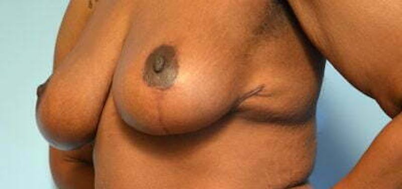 Breast Lift Before & After Gallery - Patient 399042 - Image 8