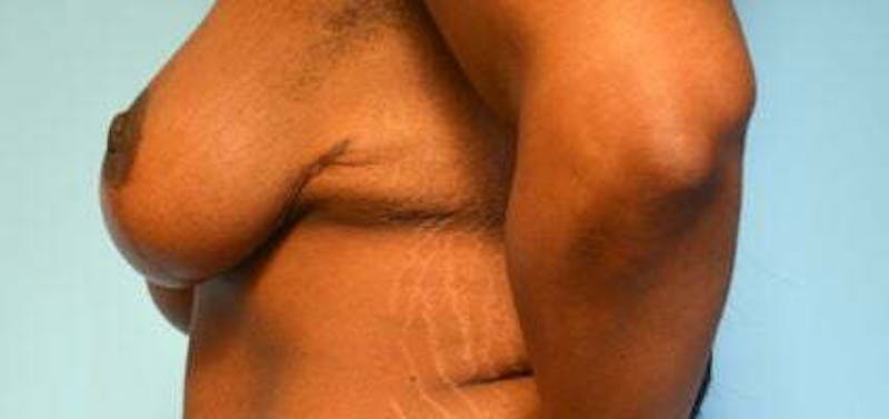 Breast Lift Before & After Gallery - Patient 399042 - Image 10