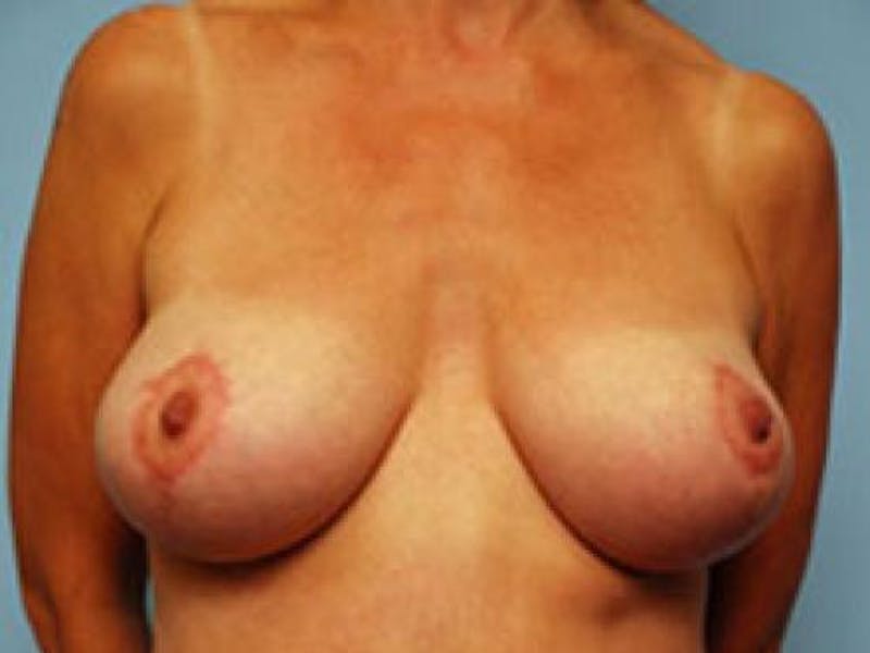 Breast Lift with Augmentation Before & After Gallery - Patient 166948 - Image 2