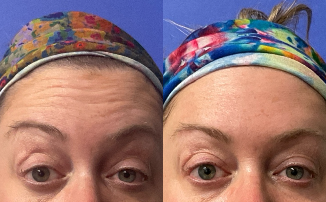 Botox Before & After Gallery - Patient 363472 - Image 1