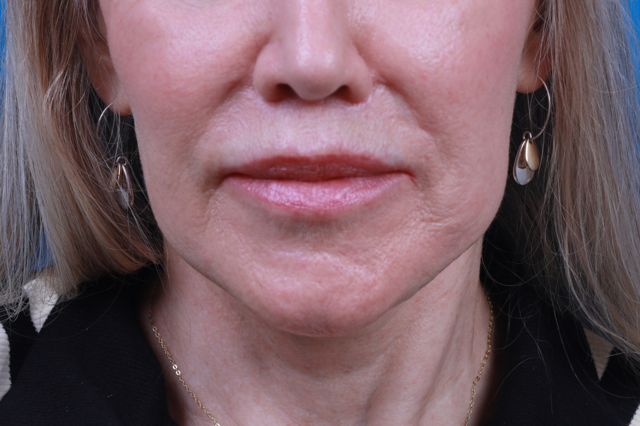 Lip Lift Before & After Gallery - Patient 404304 - Image 2