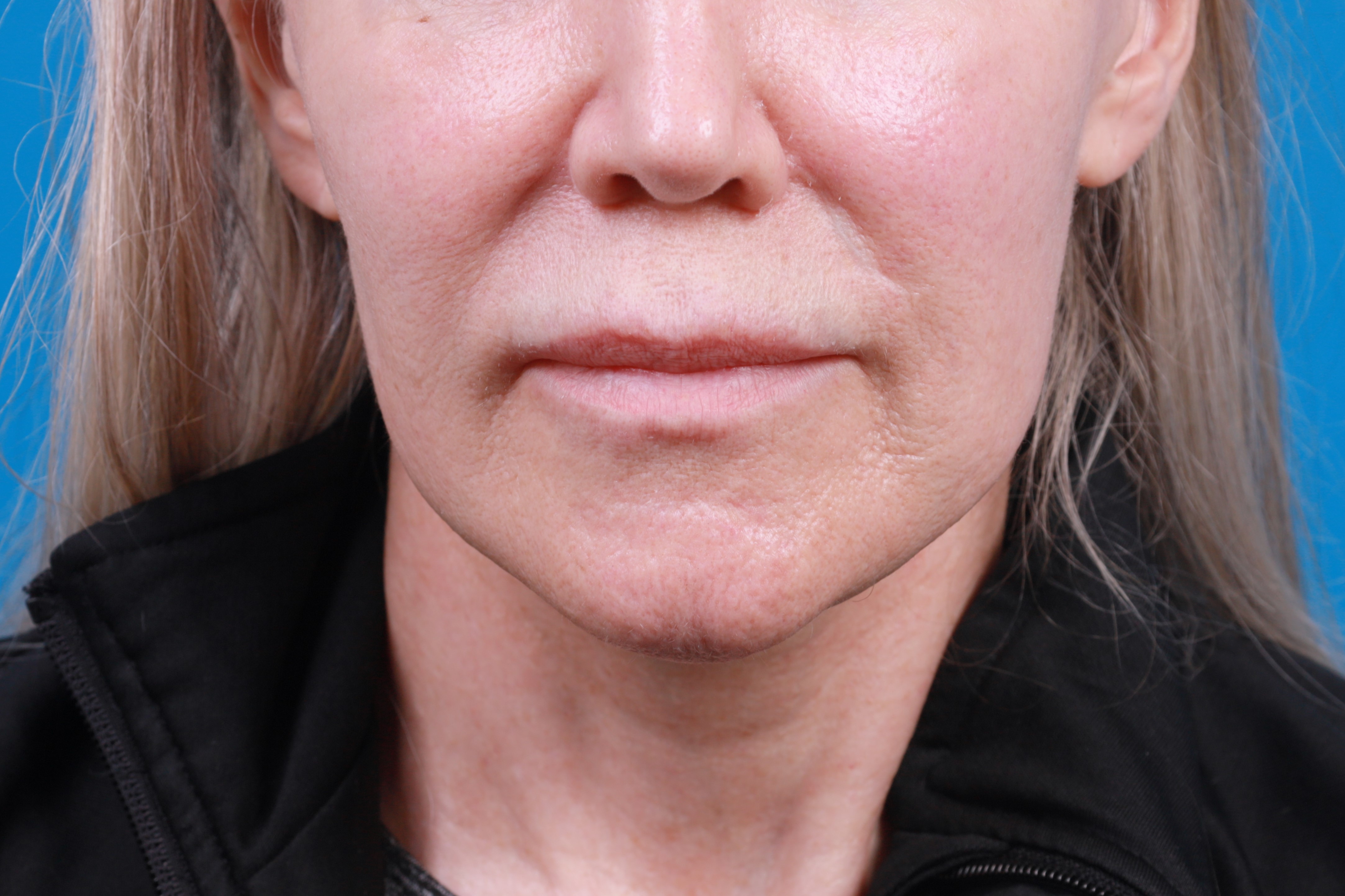 Lip Lift Before & After Gallery - Patient 404304 - Image 1