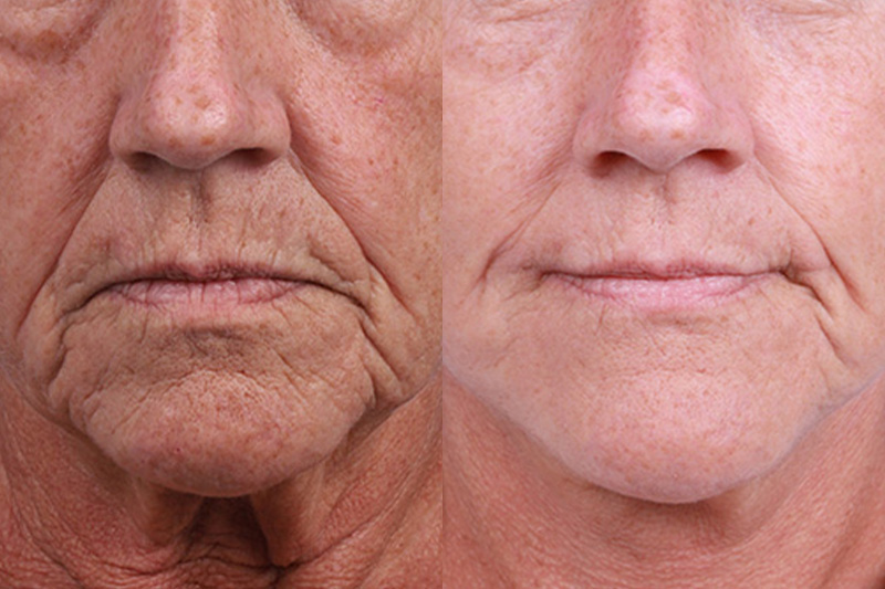Lip Lift Before & After Gallery - Patient 337009 - Image 1
