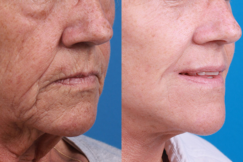 Lip Lift Before & After Gallery - Patient 337009 - Image 2