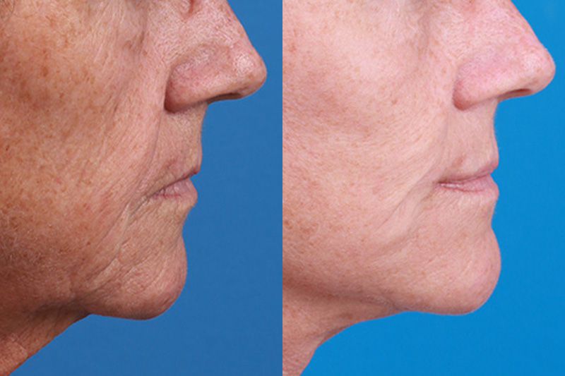 Lip Lift Before & After Gallery - Patient 337009 - Image 3