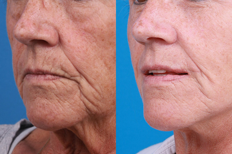 Lip Lift Before & After Gallery - Patient 337009 - Image 4