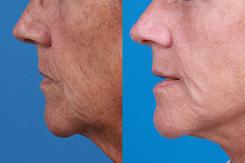 Lip Lift Before & After Gallery - Patient 337009 - Image 5