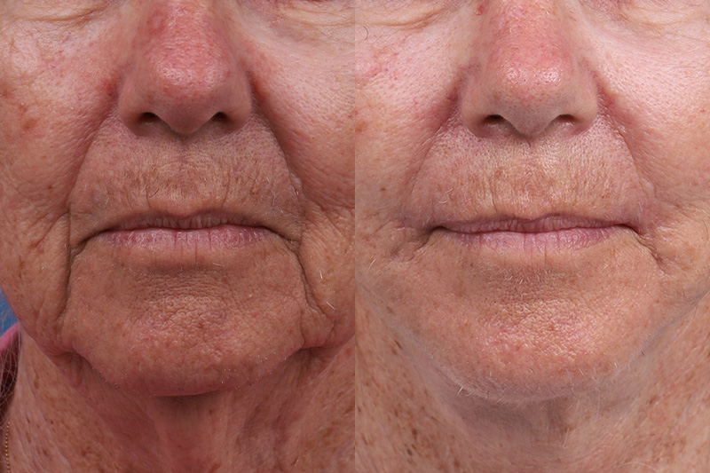 Lip Lift Before & After Gallery - Patient 184320097 - Image 1