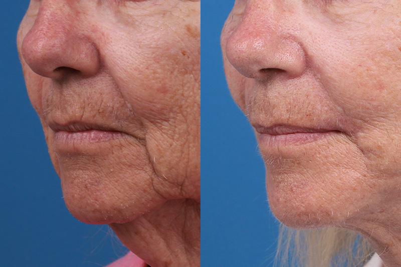 Lip Lift Before & After Gallery - Patient 184320097 - Image 4