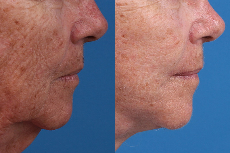 Lip Lift Before & After Gallery - Patient 184320097 - Image 3