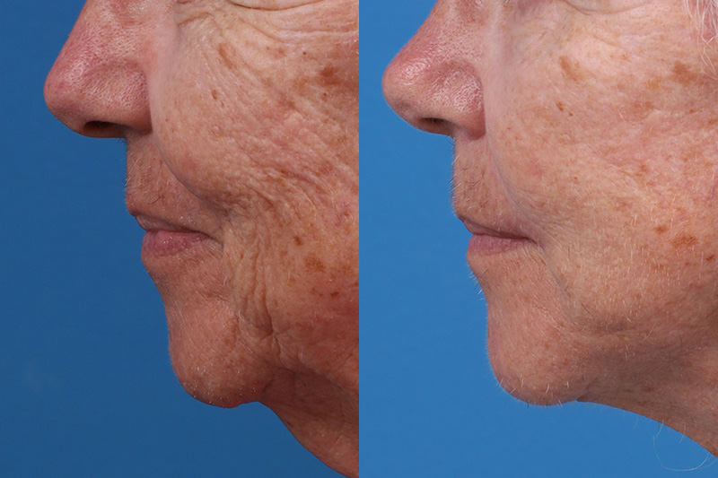 Lip Lift Before & After Gallery - Patient 184320097 - Image 5