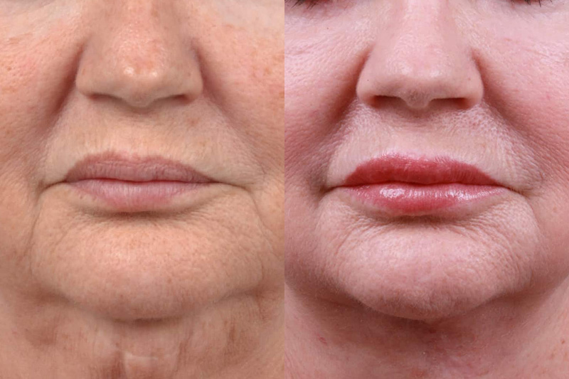 Lip Lift Before & After Gallery - Patient 122594272 - Image 1