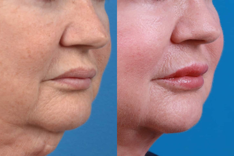 Lip Lift Before & After Gallery - Patient 122594272 - Image 2