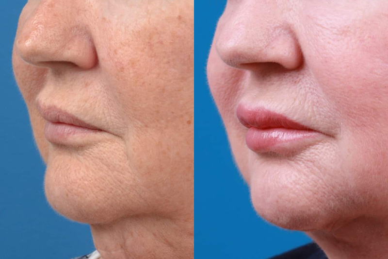 Lip Lift Before & After Gallery - Patient 122594272 - Image 3