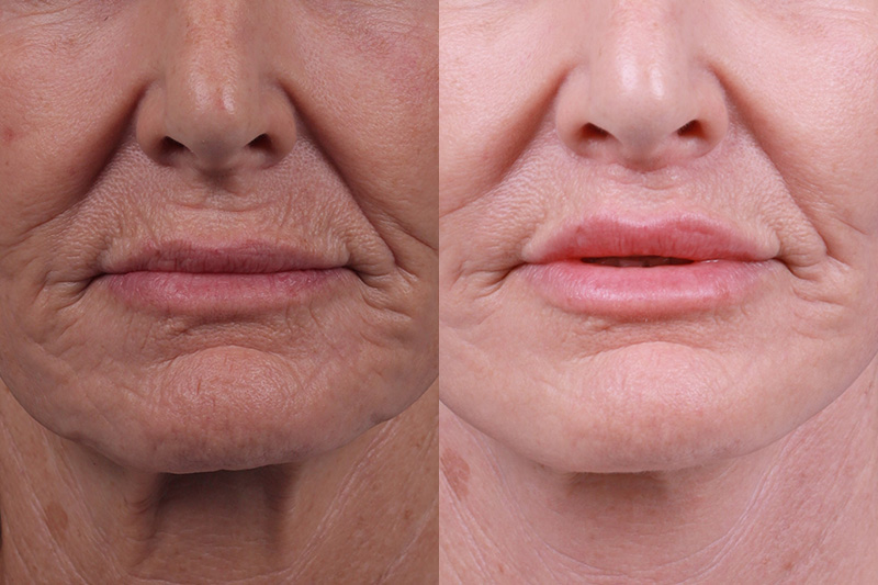Lip Lift Before & After Gallery - Patient 122406908 - Image 1
