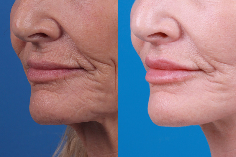Lip Lift Before & After Gallery - Patient 122406908 - Image 2